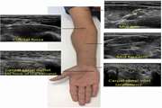 The ultrasonographic correlates of carpal tunnel syndrome in patients with normal electrodiagnostic tests